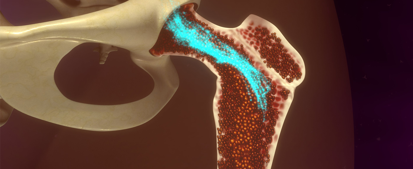 Multiple myeloma developing inside bone marrow