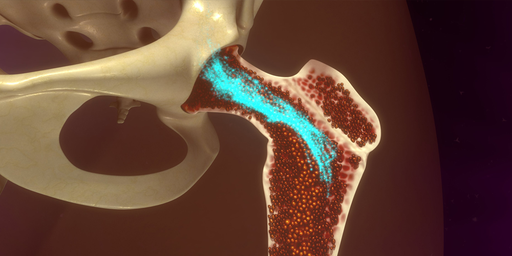 Multiple myeloma developing inside bone marrow